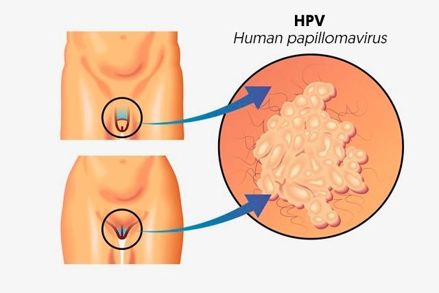 Papillomavirus homme traitement naturel. Papillomavirus chez homme traitement
