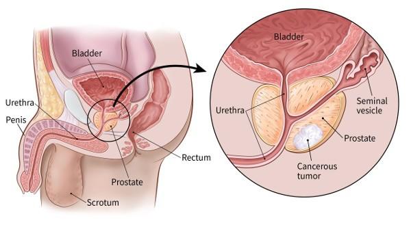 cancer / prostate phase terminale symptômes