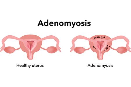 Adenomyosis honorhealth 1 