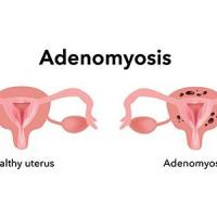 Adenomyosis honorhealth 1 