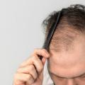Alopecie traitement naturel 1