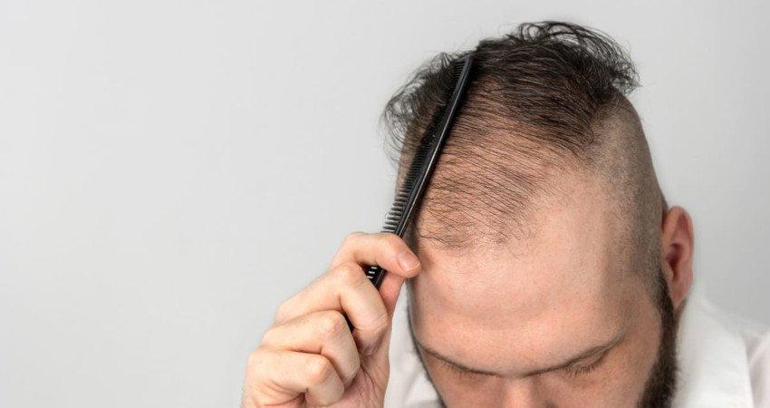 Alopecie traitement naturel