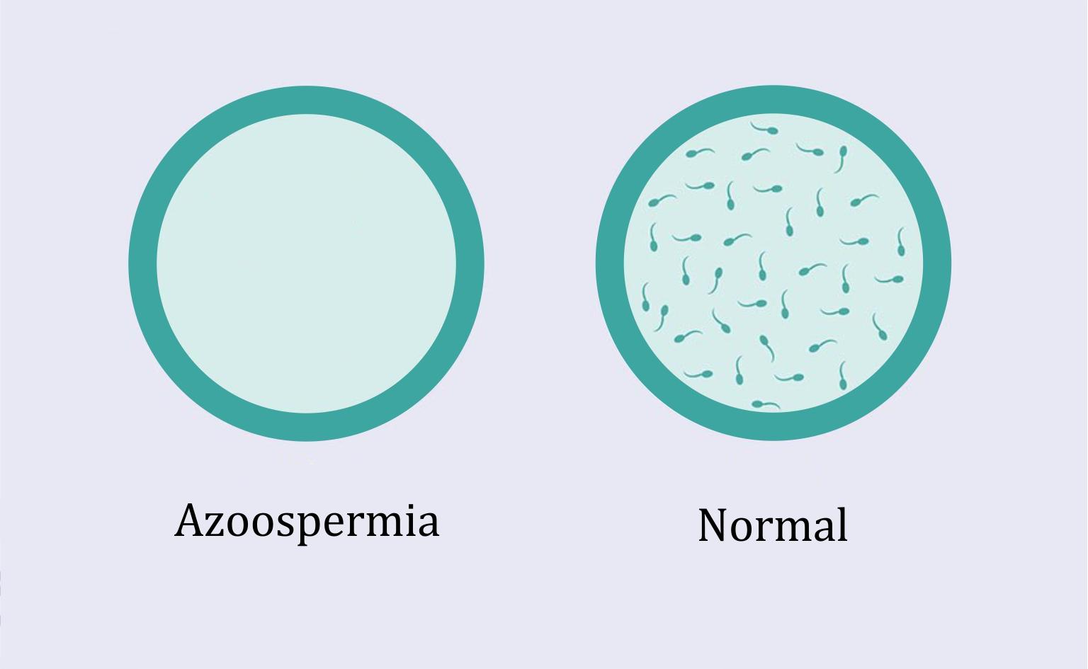 Azoospermia and normal
