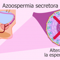 Azoospermia secretora
