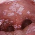 Chlamydia throat