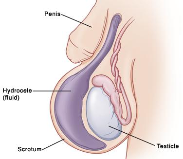 Closeup of babys penis and scrotum showing testicle inside large sac of fluid hydrocele is inside scrotum and enlarging it