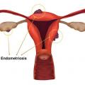 Endometriosis illustration fcc644