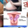 Fibromes et grossesse