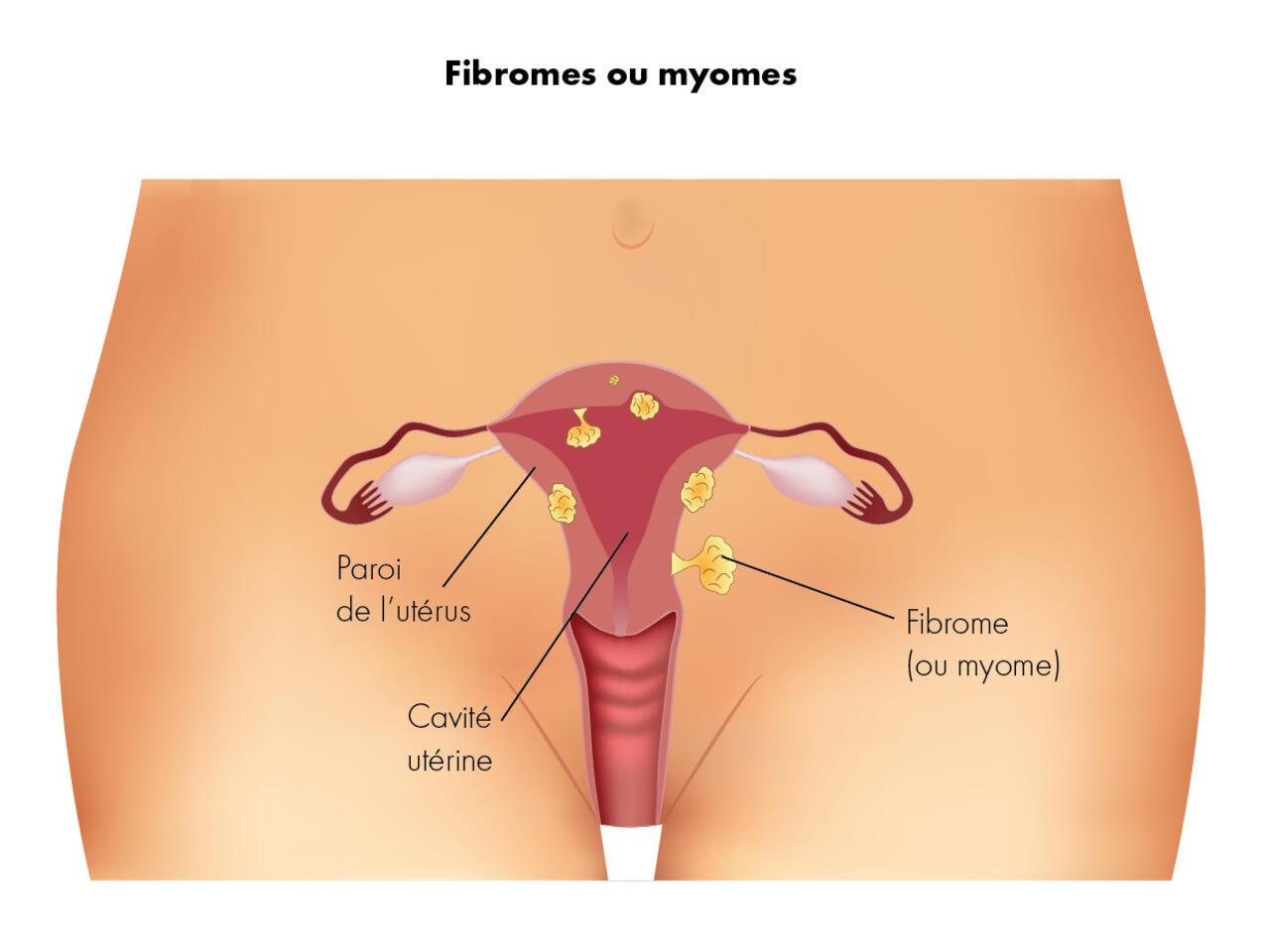 Fibromes uterins
