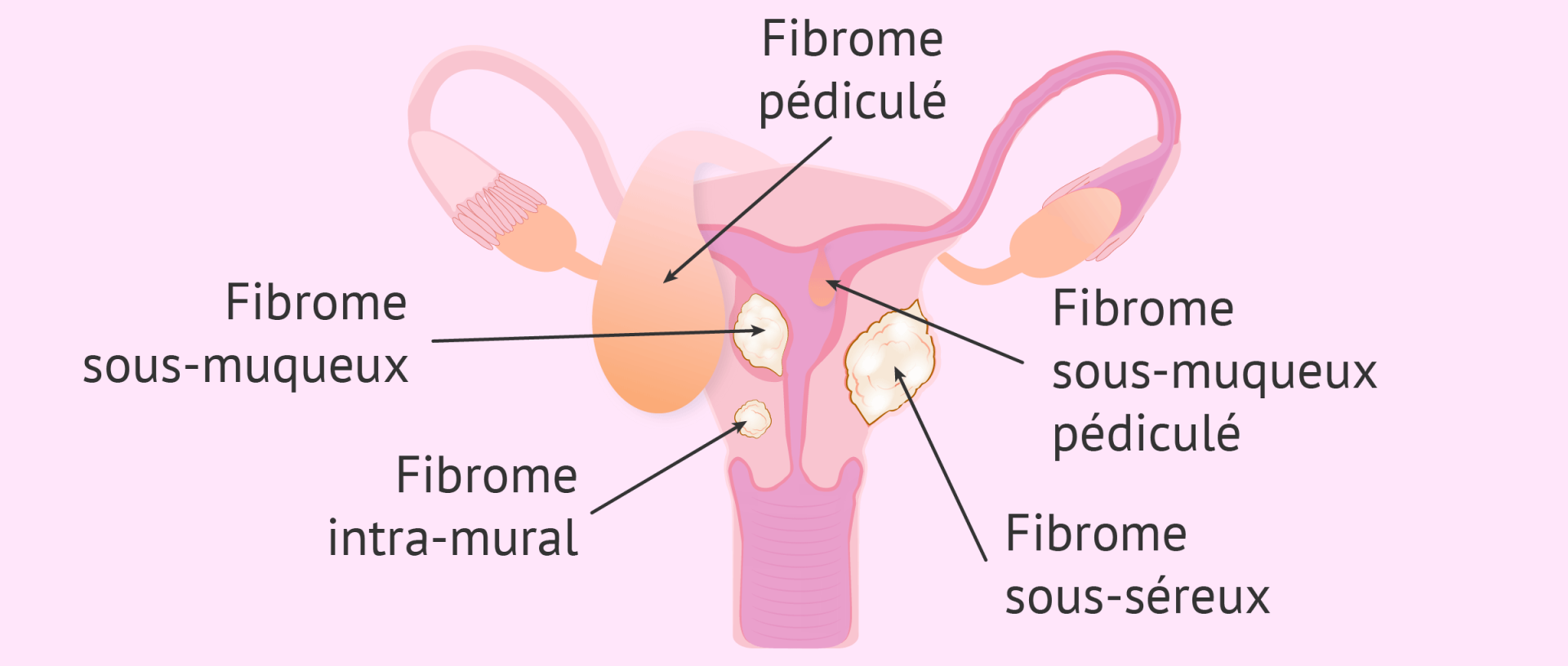 Fibromes uterins