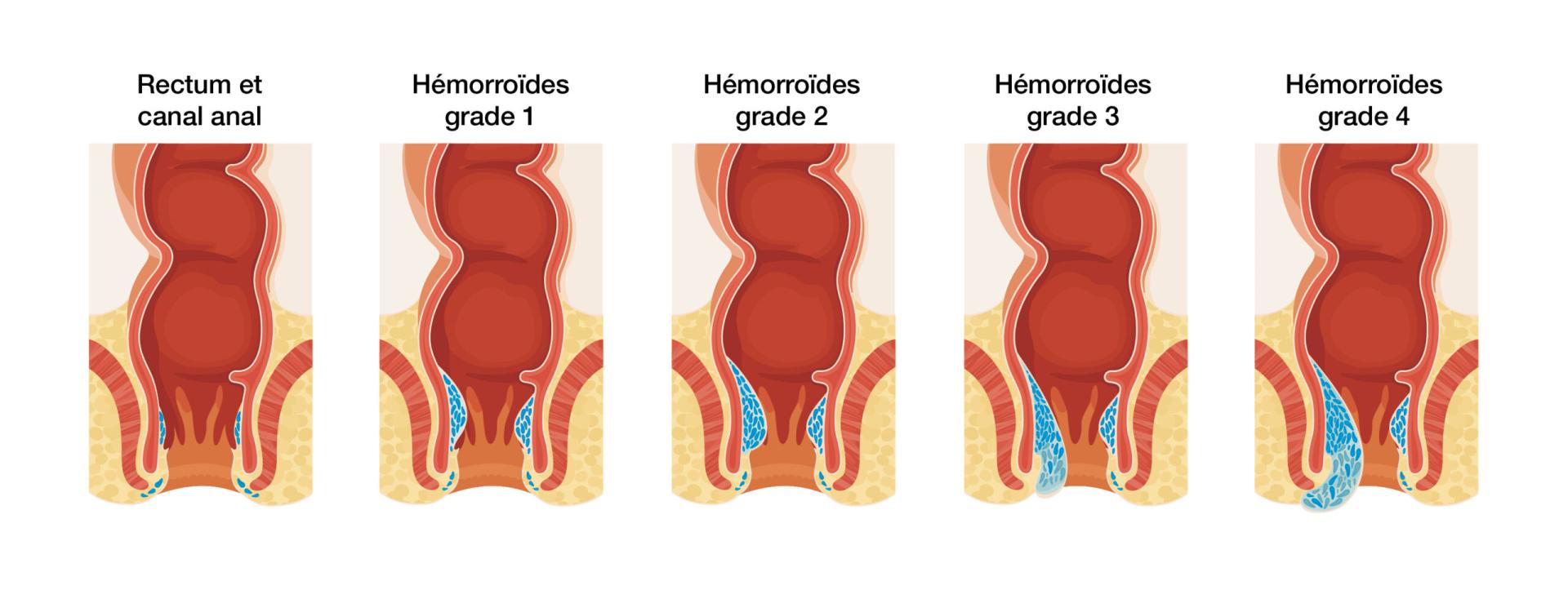 Hemorroides