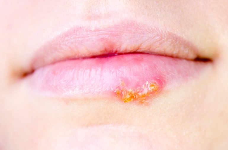 Herpes: causes, symptoms and natural treatment