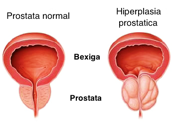 a prosztatitis ovális kezelése