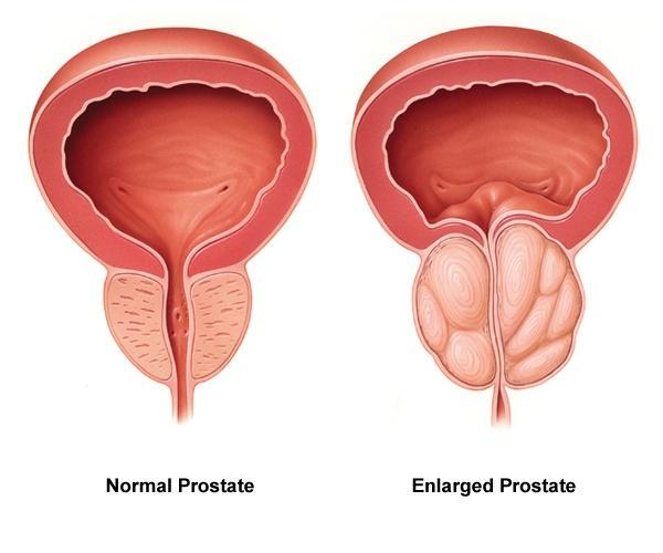 Hyperplasie be nigne de la prostate