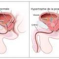 Hypertrophie benigne de la prostate 1
