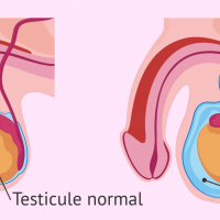 L hydroce le testiculaire