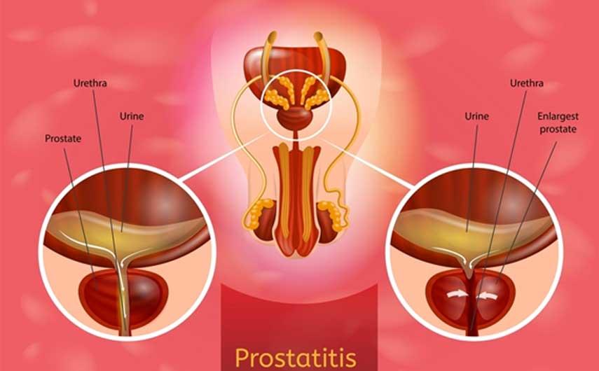 Prostatitis sumamed