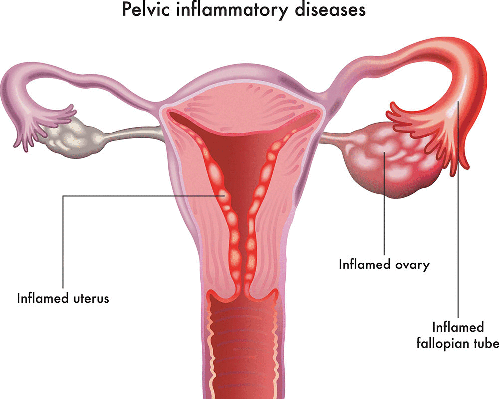 Pelvic inflammatory diseases 9f28f7