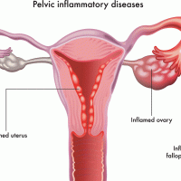 Pelvic inflammatory diseases 9f28f7
