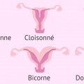 Polypes uterin taille