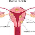 Preferred vascular uterine fibroids 1024x536