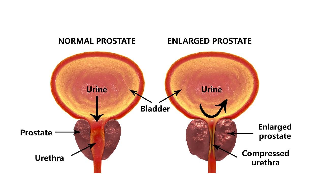 Prostatitis valerian