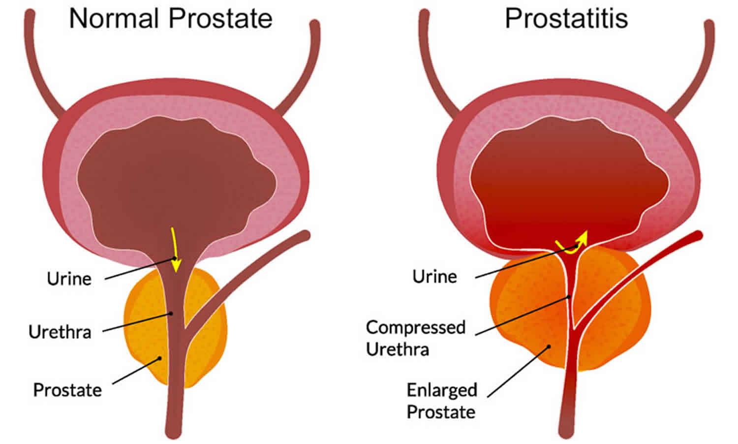 Vitaprost cystitis Phytotherapy for prostatitis