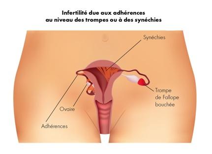 Sinequia uterina: causas, síntomas y remedios naturales