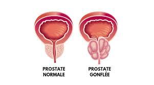 prostatite cause et traitement