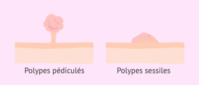Types de polypes uterins