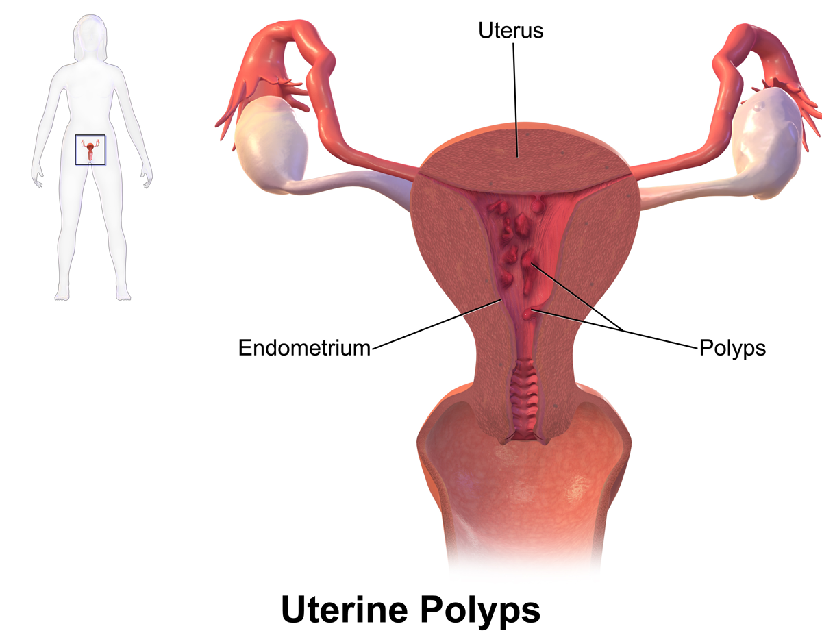 Uterine polyps 1 