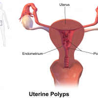 Uterine polyps 2 