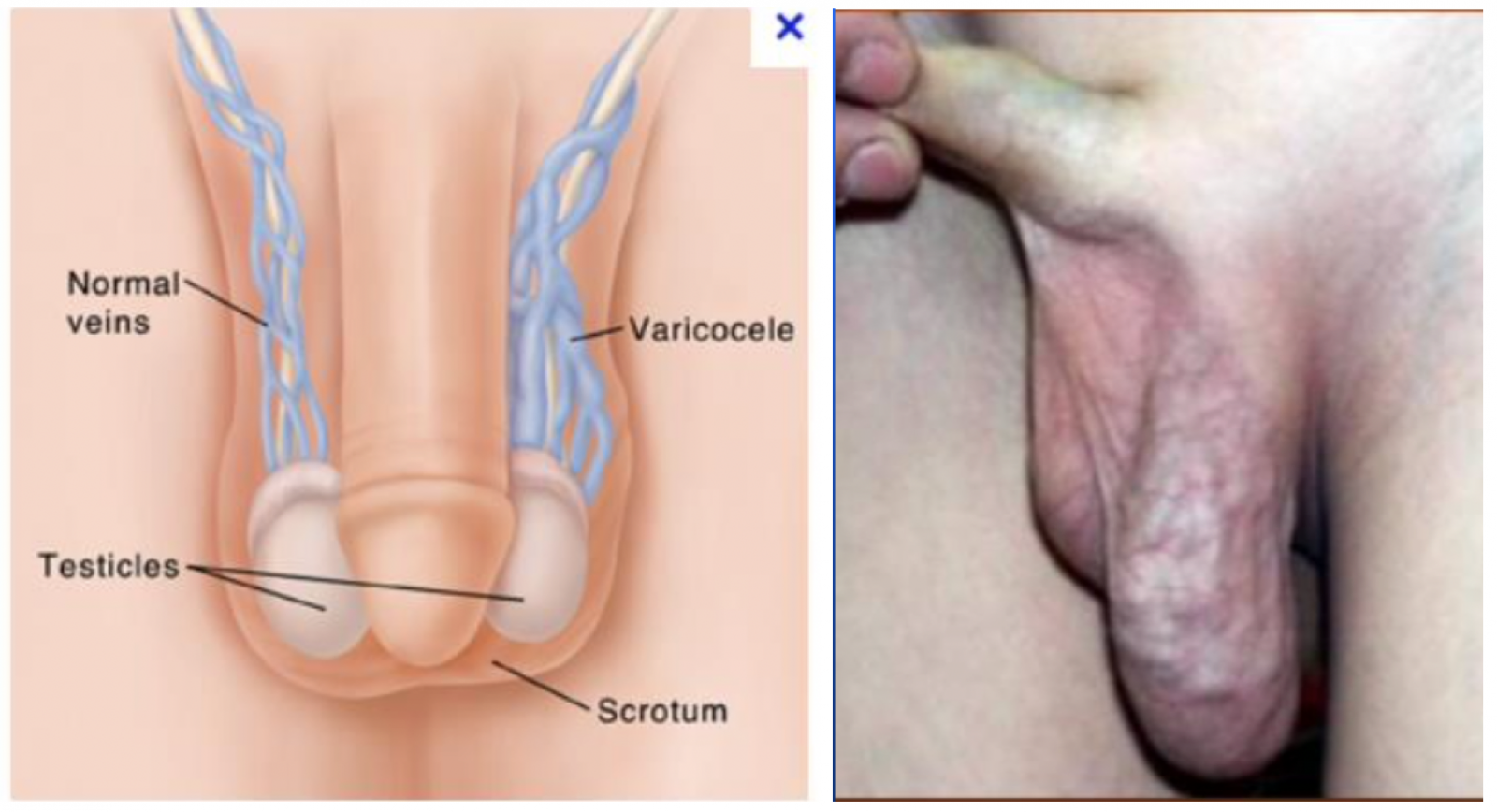 Varices testiculaires varicocele