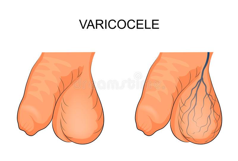 Varicocele 2